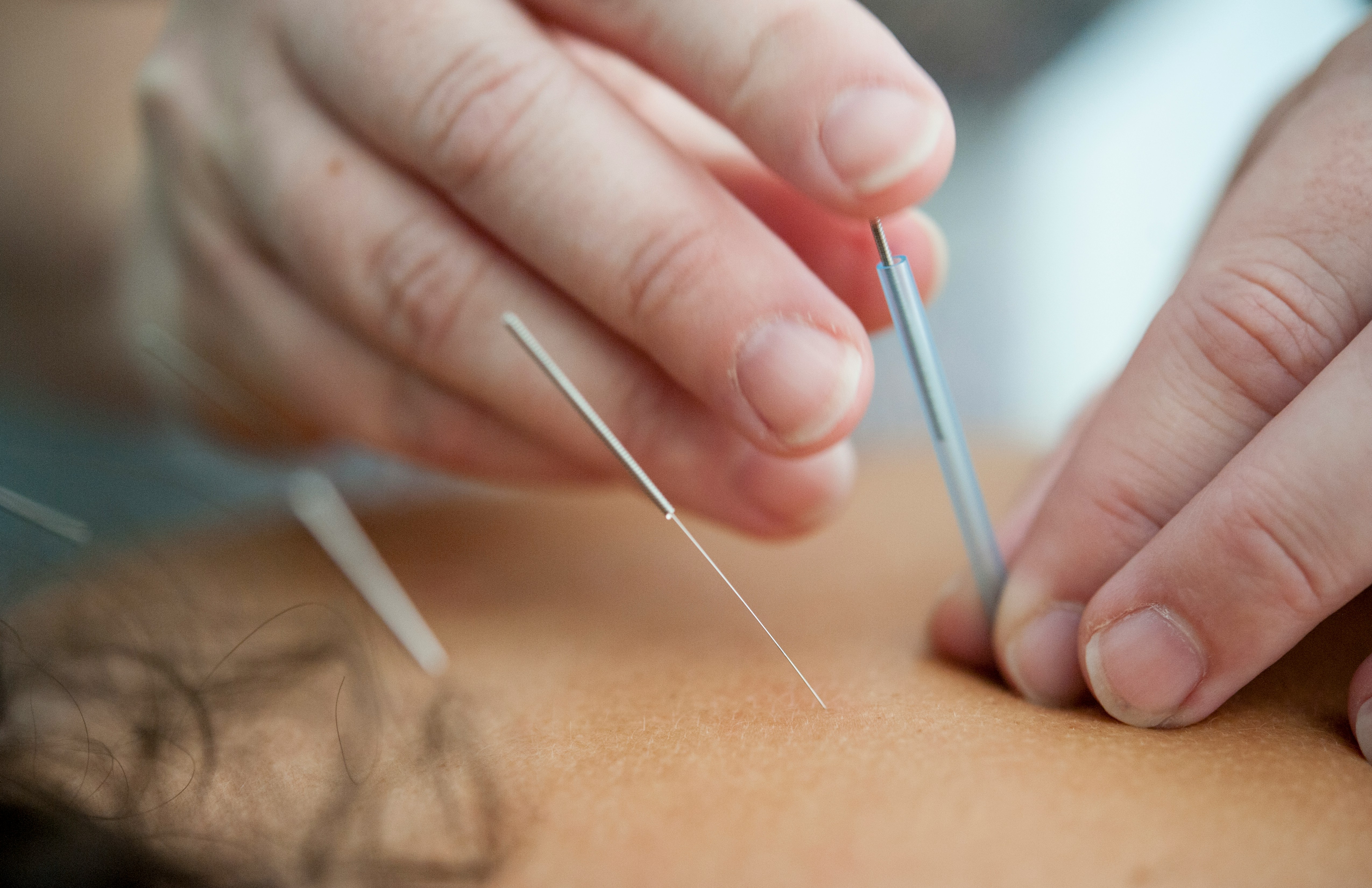 What Does Acupuncture Actually Do to Your Body?