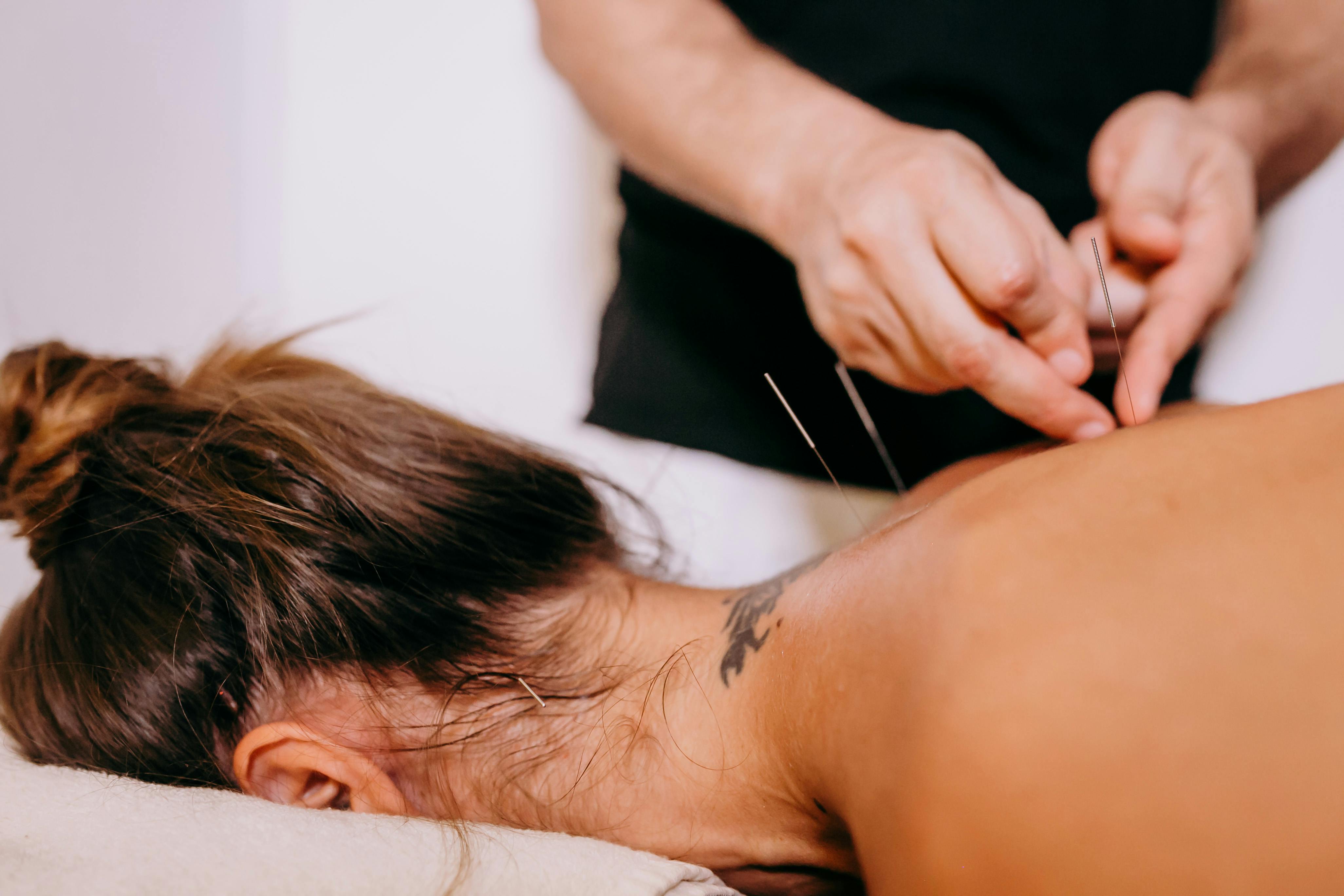 Woman with acupuncture needles in back.