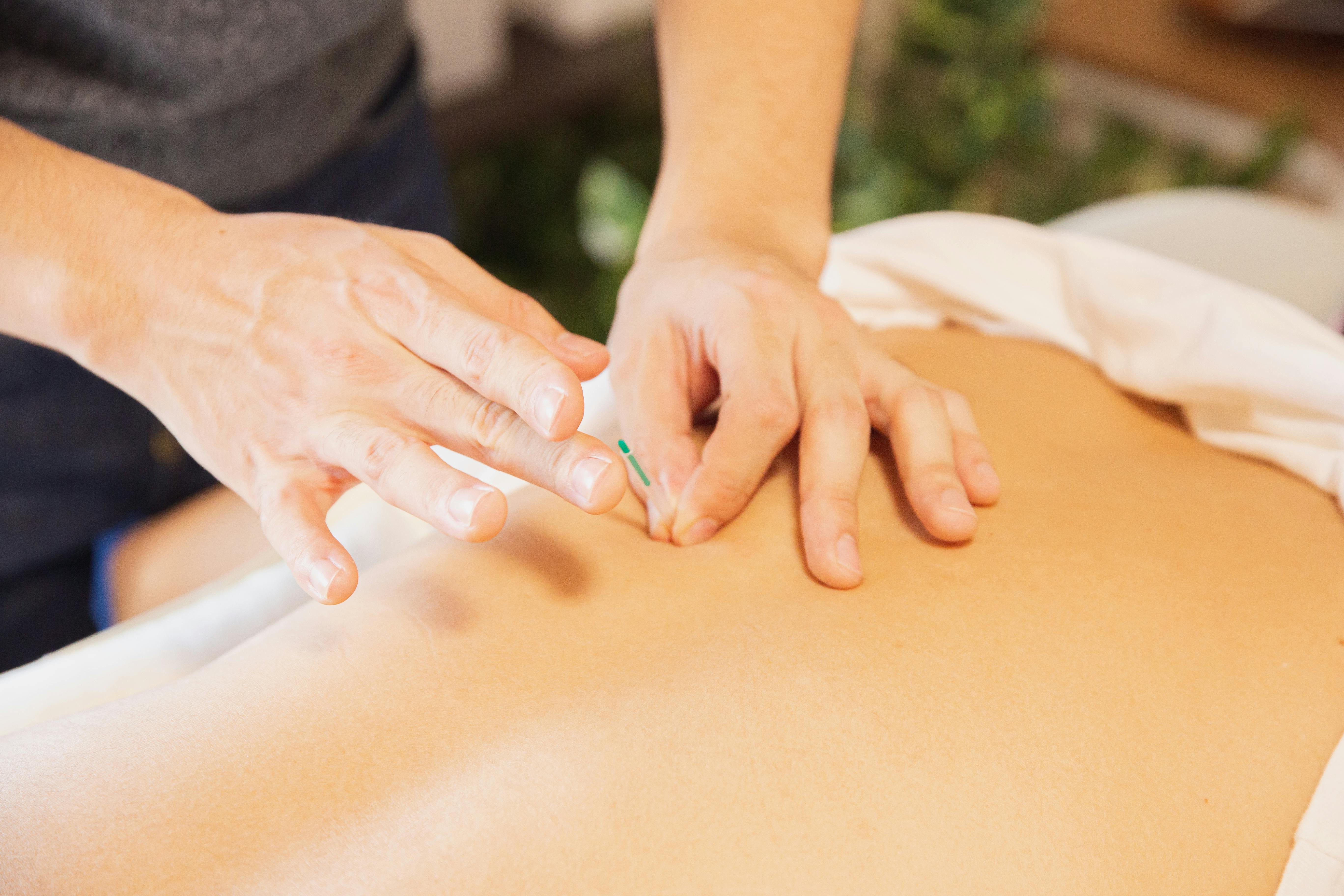 What is Acupuncture? Understanding the Basics