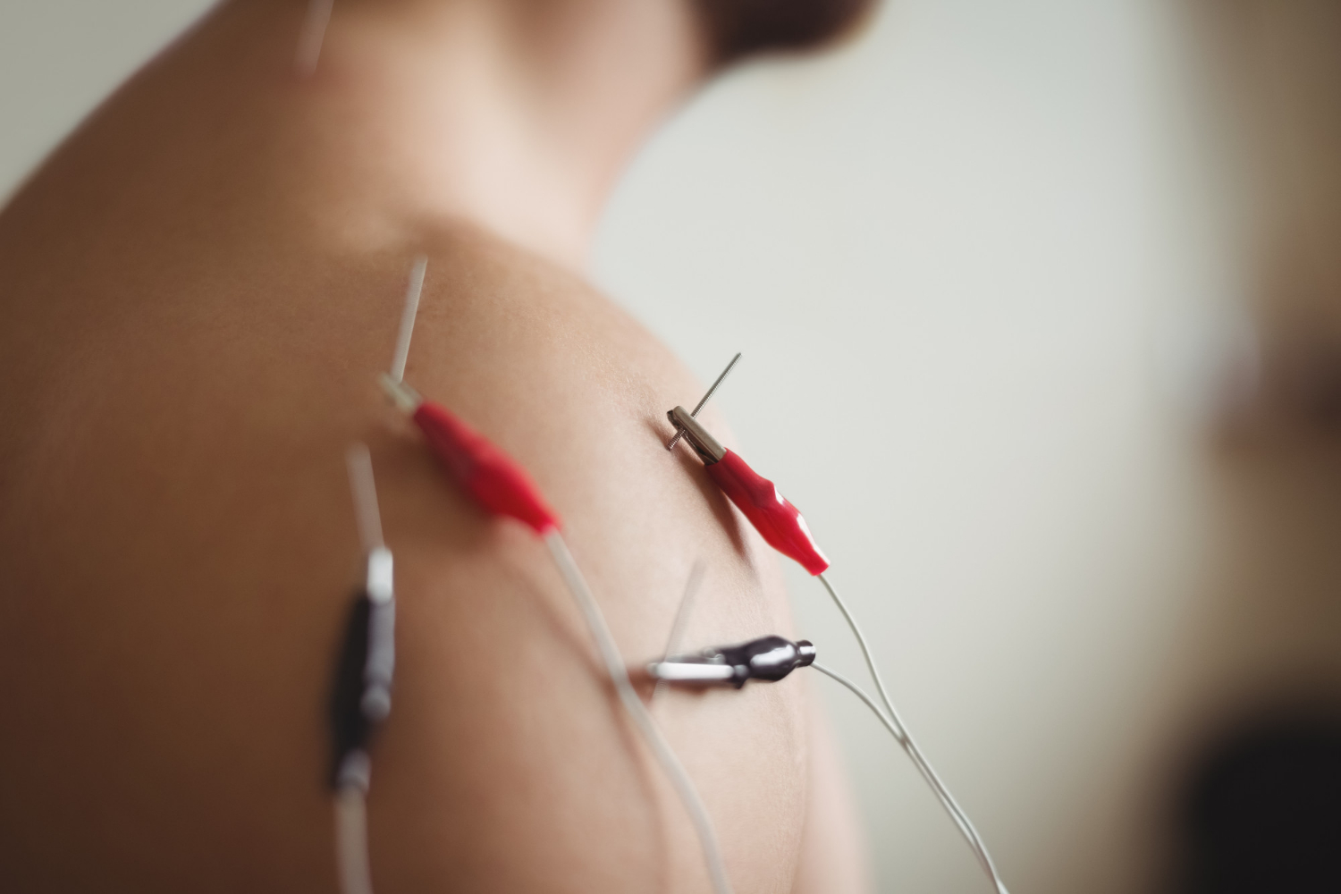 7 Different Types of Acupuncture to Consider