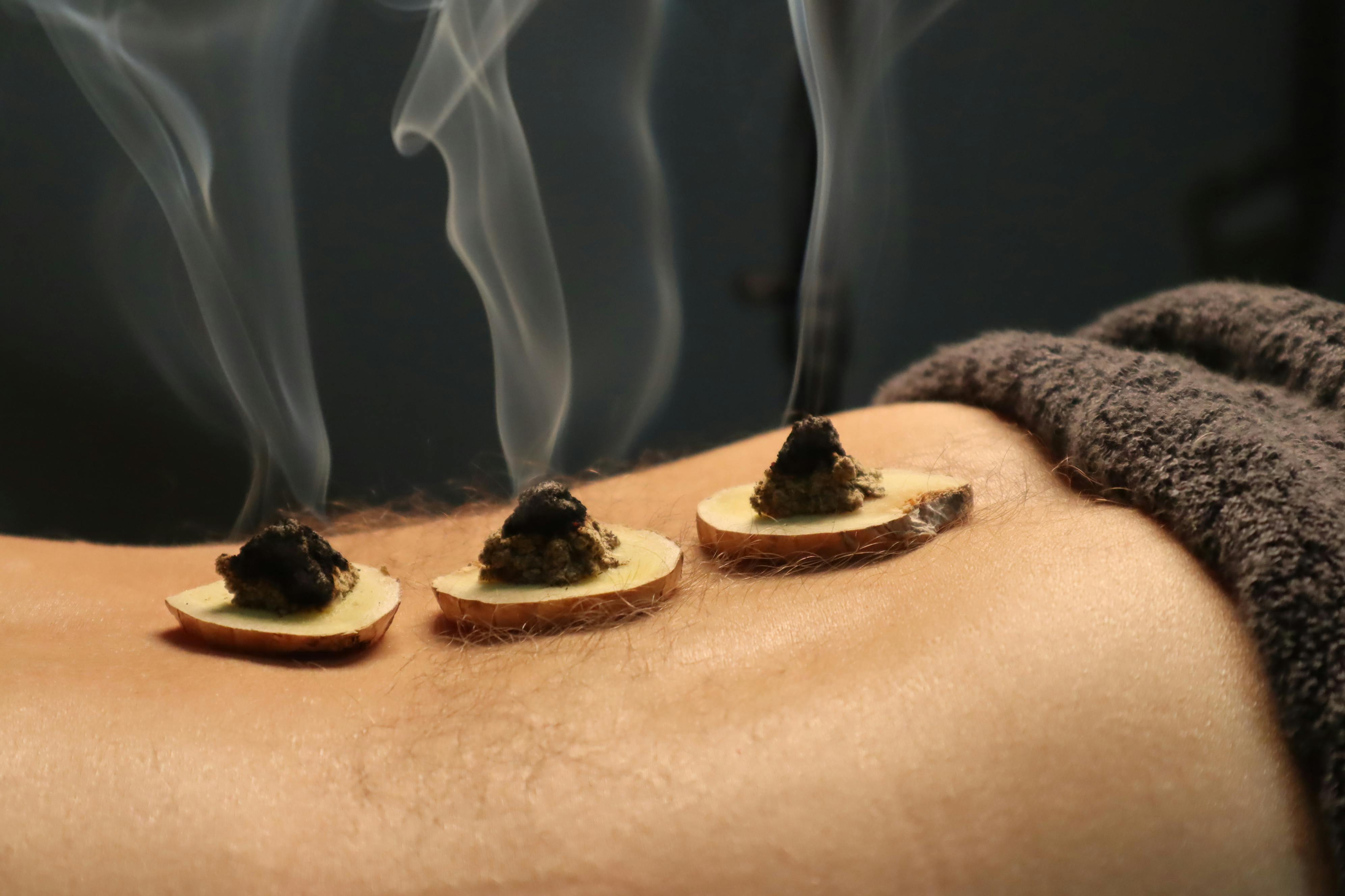 Moxibustion 101: How to Use Heat to Heal at Home